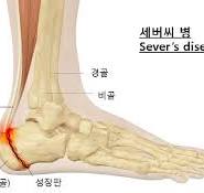 발뒤꿈치 통증 원인별고 정확히 알아보자