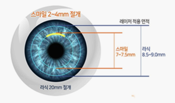 스마일라식 장점 사진