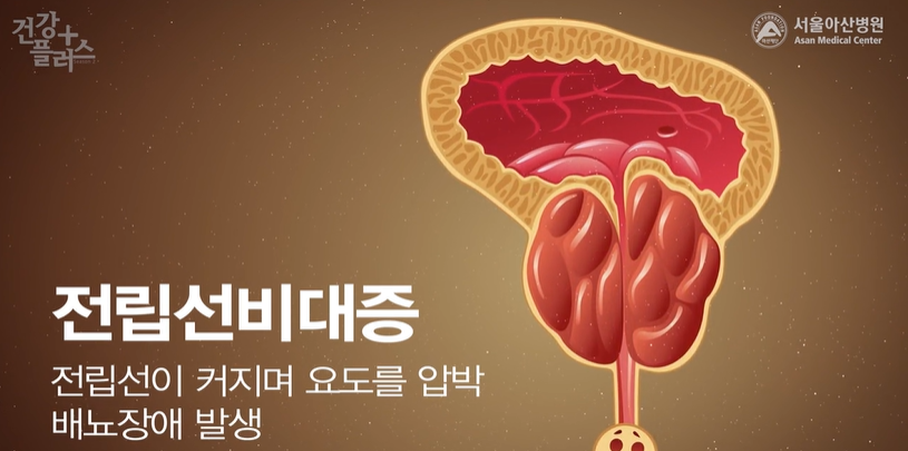 전립선비대증 증상