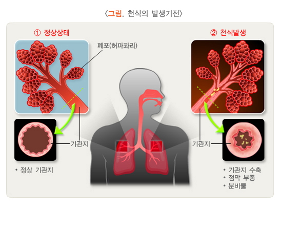 천식 증상