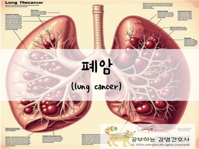 폐암(lung cancer)의 원인 및 증상, 치료법 및 생존률
