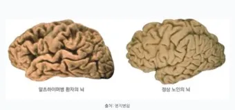 알츠하이머와 치매 차이_2