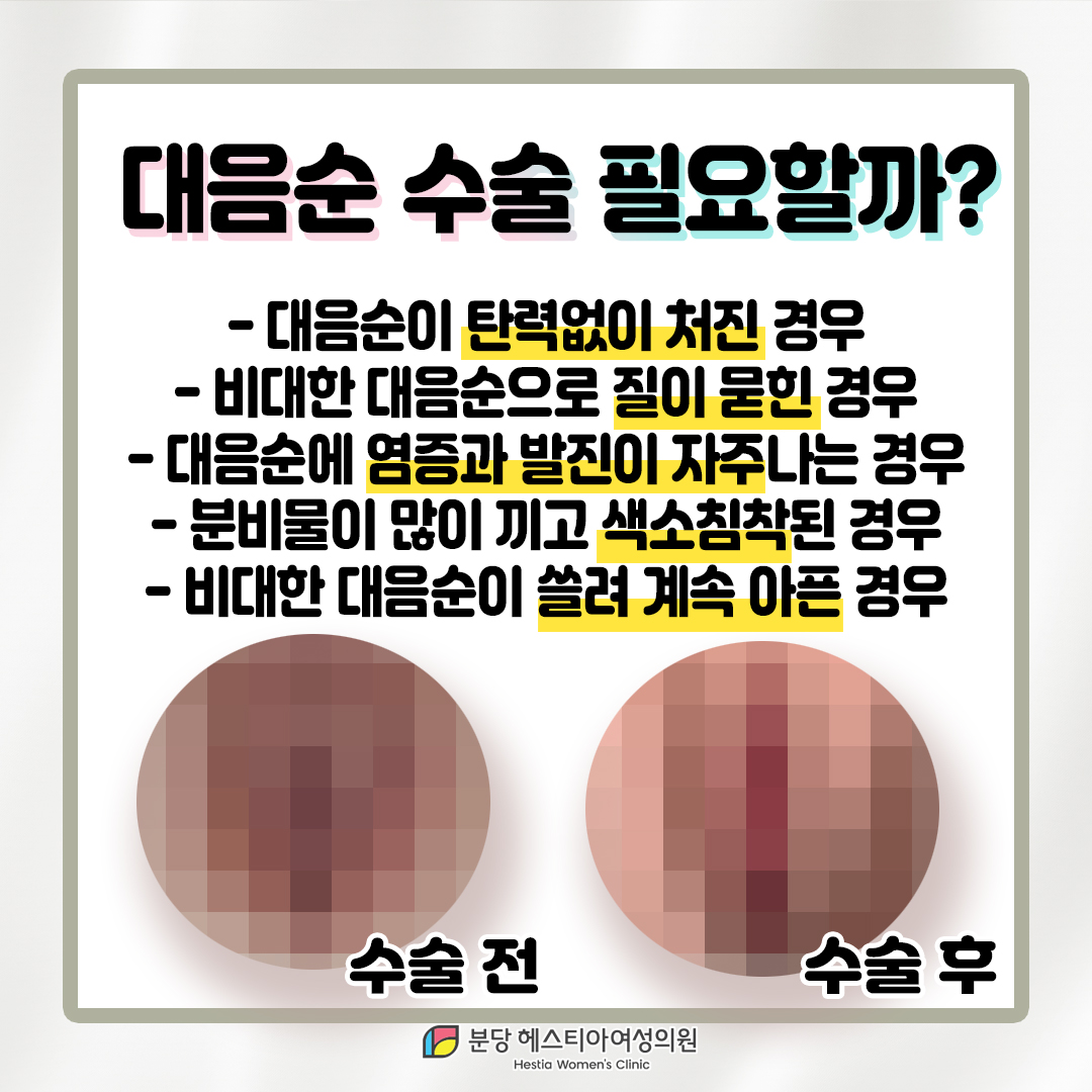 죽전동 산부인과 생식기 발진 회음부아픔 혹시 나도 대음순 수술 대상자?