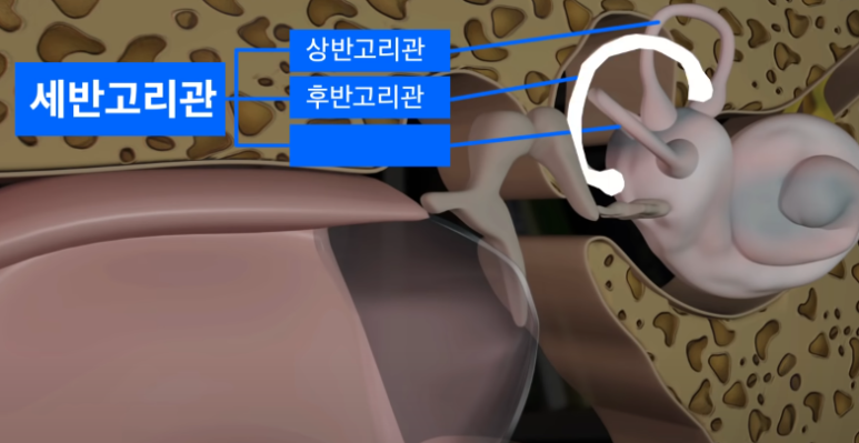 이석증 관련사진