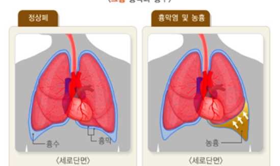 왼쪽 갈비뼈 아래 통증