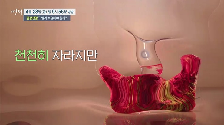 갑상선-모형-찌그러진-모습
