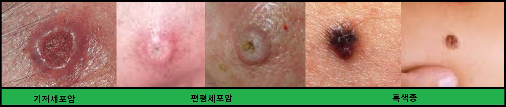  피부암, 3대 피부암, 기저세포암, 편평세포암, 흑색종
