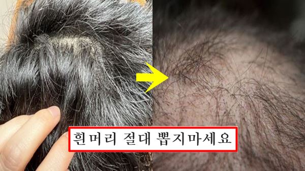 흰머리카락 탈모