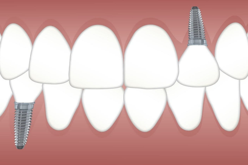 치아의-중요성-및-임플란트-시술-사진