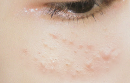  여드름 짜야하나(압출) 말아야 하나? 좁쌀는 짜지말고, 화농성은 짜도 된다. 채희중 전문의 의견