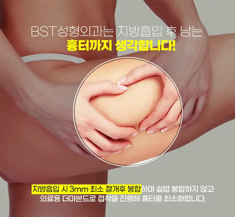 지방흡입 시 3mm 최소절개 봉합하며 실밥 봉합하지 않고 의료용 더마본드로 접착을 진행해 흉터를 최소화합니다.