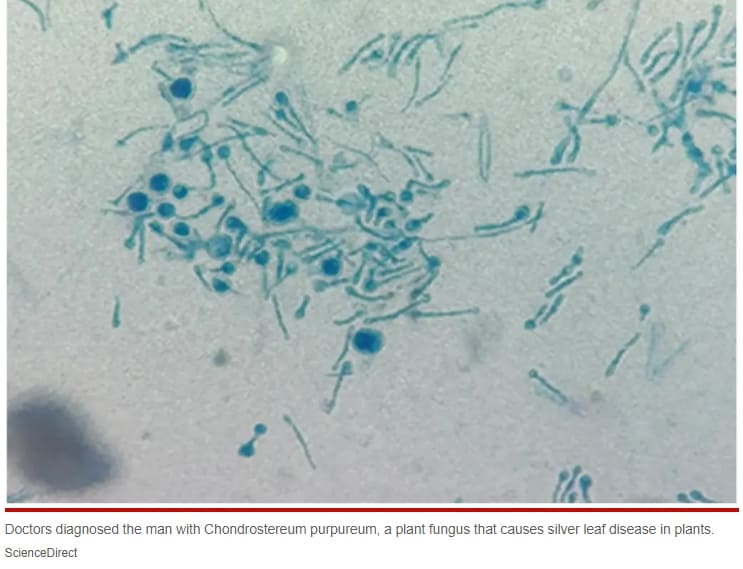 한 남성, 세계 최초 곰팡이에 의한 '식물성 진균병' 감염 사례 Man infected with deadly plant fungus in world-first case