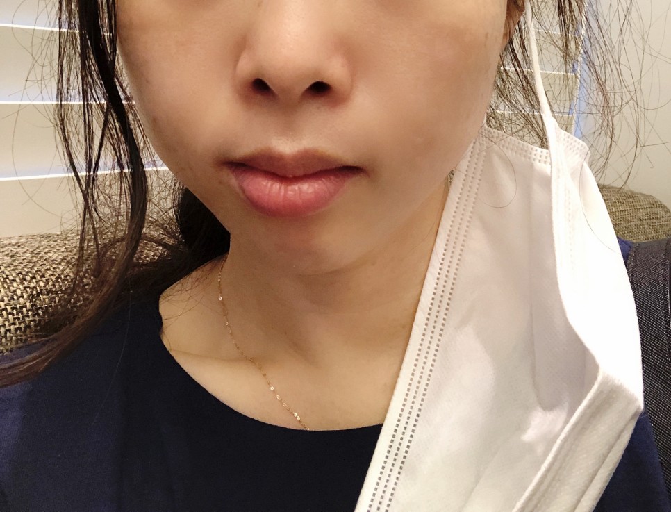 콧볼 축소 비용 [강남/보톡스] 콧볼축소주사-후기 5