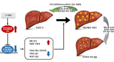 지방간이미지