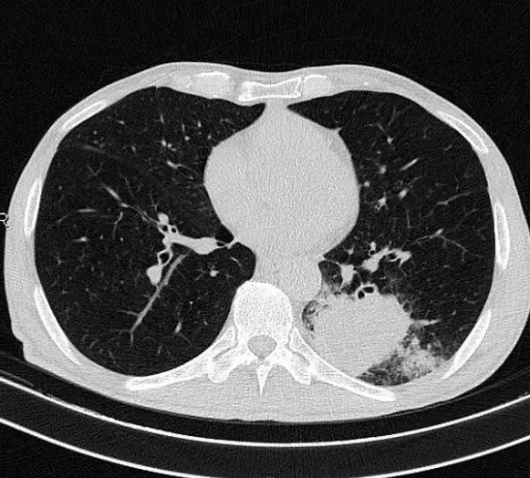 lung squamous cell carcinoma