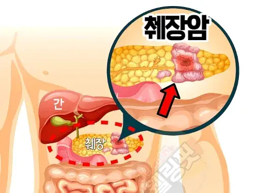 췌장의-위치와-췌장암-발생부위