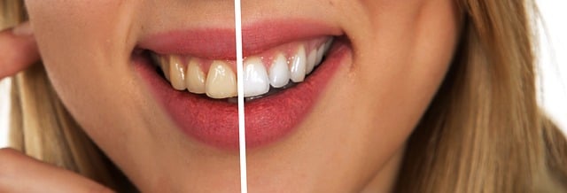 여성-하얀이빨과-누런이빨