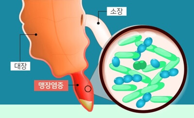 오른쪽 왼쪽 옆구리 뒤쪽 통증