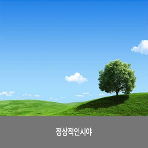 정상적인 시야