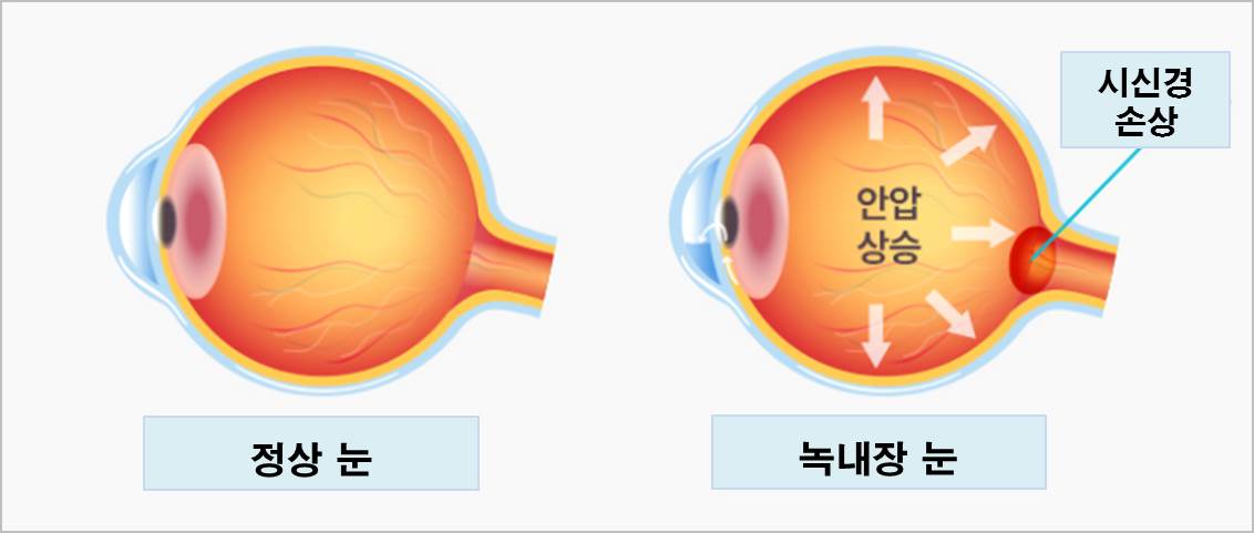 녹내장