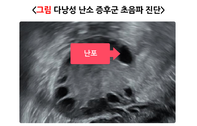 다낭성_난소_증후군_진단