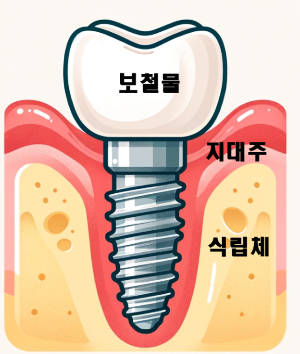 임플란트 구조