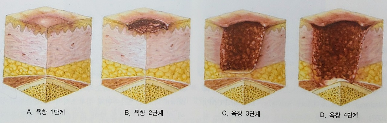  욕창의 원인과 증상, 욕창 단계 총정리