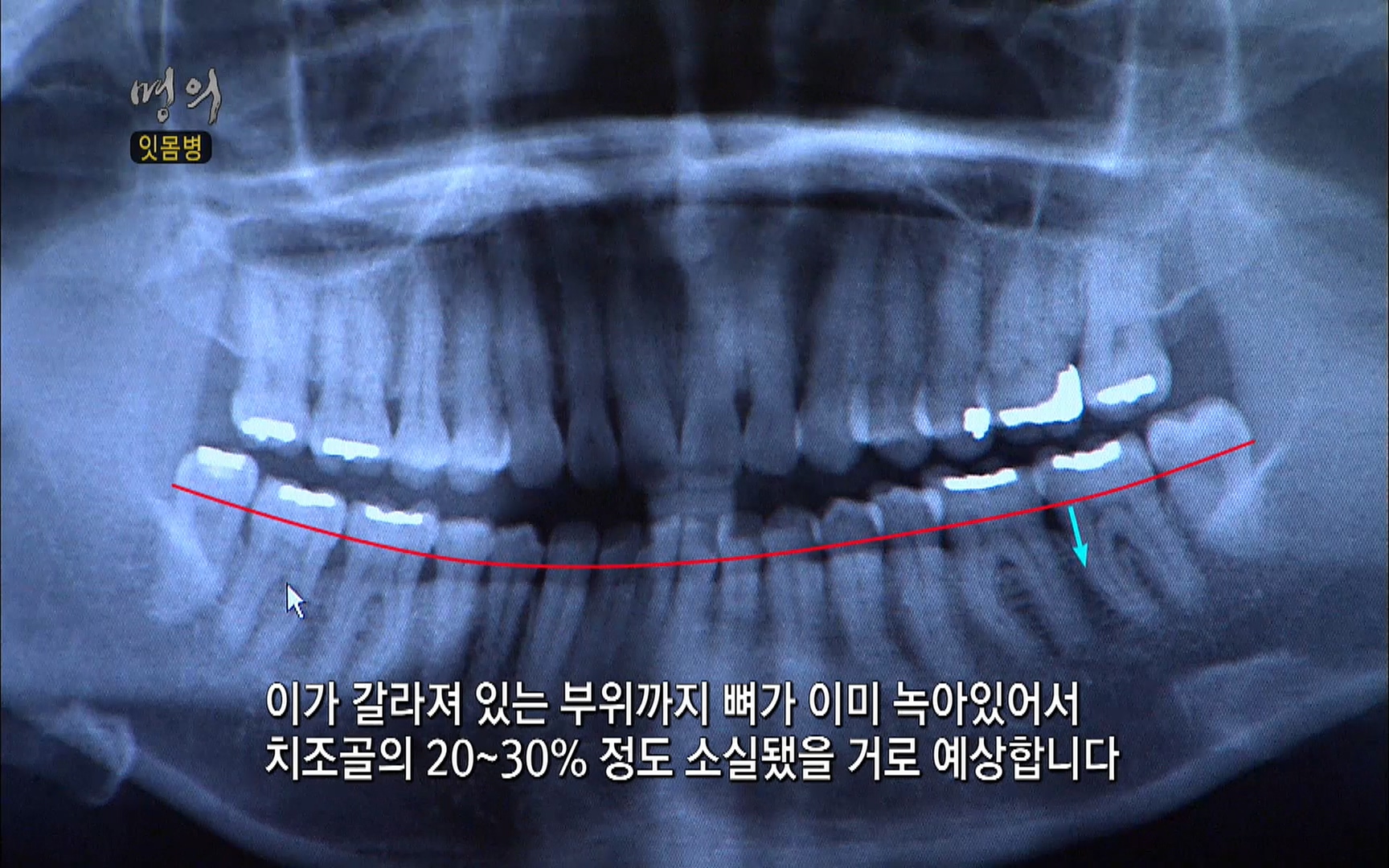 EBS 명의 헬스케어 - TV - 교육의 중심 EBS2015년 1월 16일 (금) 밤 9시 50분, EBS1.mp4_20220505_150353.398.jpg