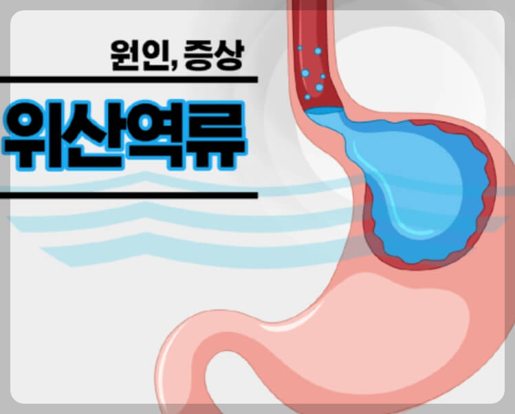 위산 역류 증상과 막는 방법