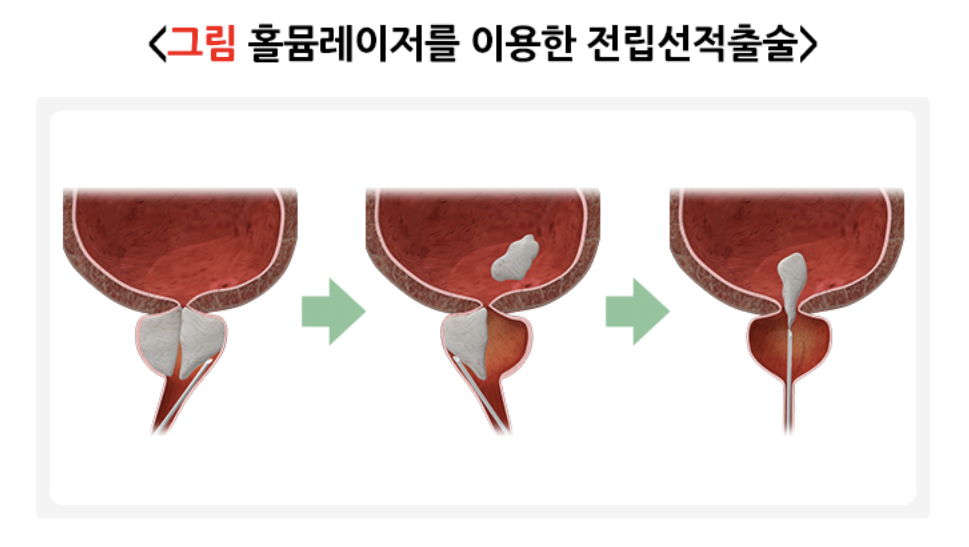 전립선 적출술