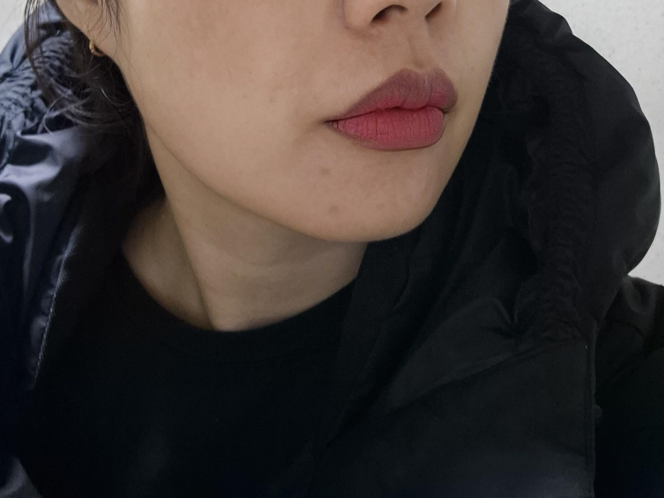 의정부피부과 윤곽주사