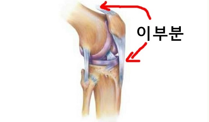 인대사진