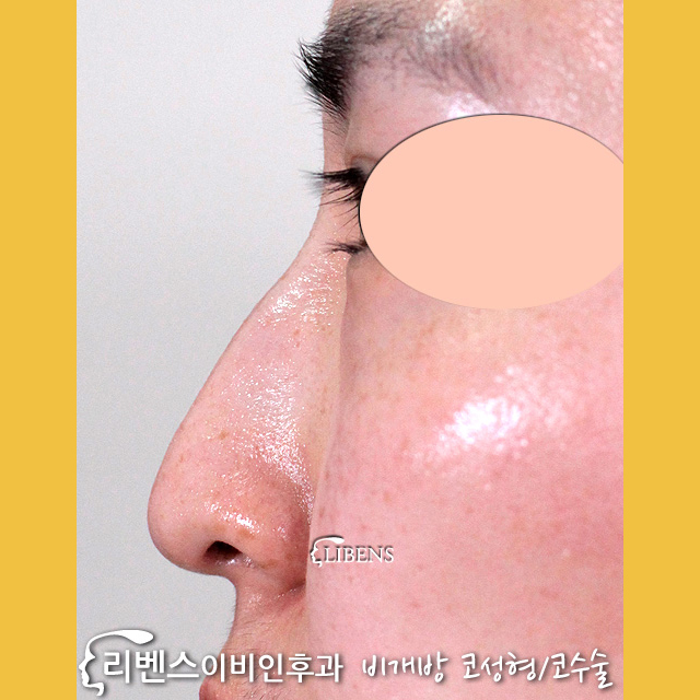 신사역코성형 비염 코수술 재발없이 7