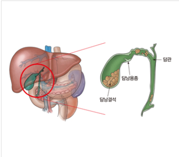  쓸개담석/담낭결석/담석증 증상