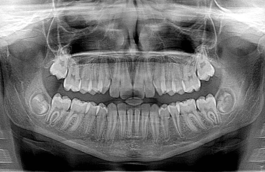 잇몸 사랑니 통증 엑스레이