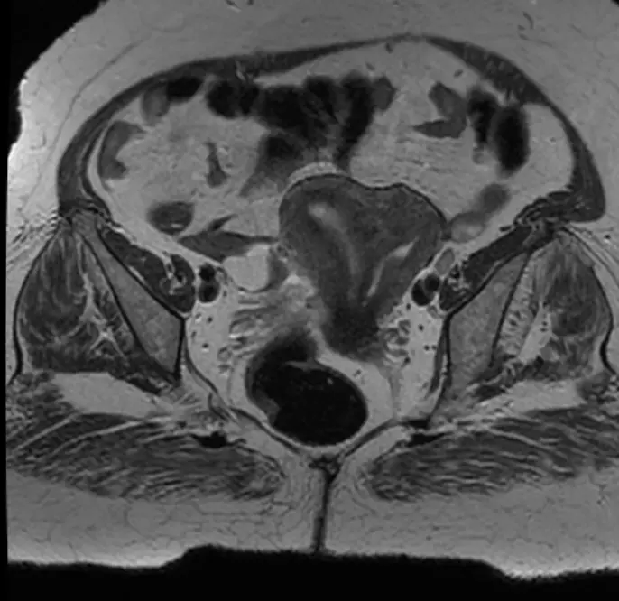 중격자궁의 MRI 소견