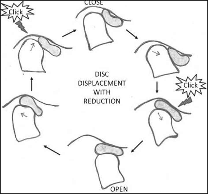 턱관절의 비정상적인 움직임을 나타낸 그림으로 클릭 사운드가 어느 부위에서 나타나는지 나타낸 그림