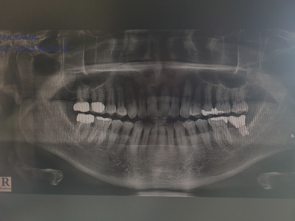 치아 상태를 한 눈에 볼수 있는 파노라마 촬영 판독사진