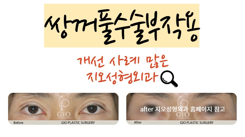 두꺼운 쌍꺼풀 없애는법 두꺼운 쌍꺼풀 없애는법