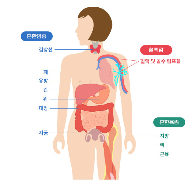 암 발생 부위