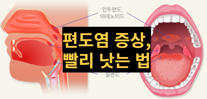  [건강정보] 편도염 증상과 빨리 낫는 법 살펴봐요.