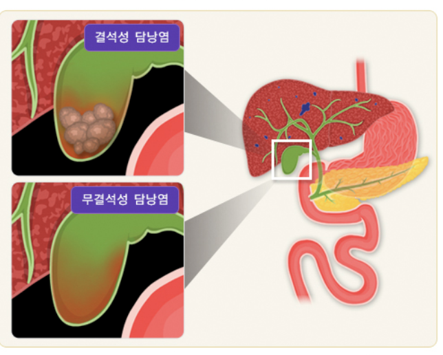 담낭염의 증상 12가지 총정리 섬네일