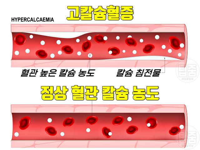 목이 마르는 증상 목이 건조하고 칼칼 갈증 원인 고칼슘혈증