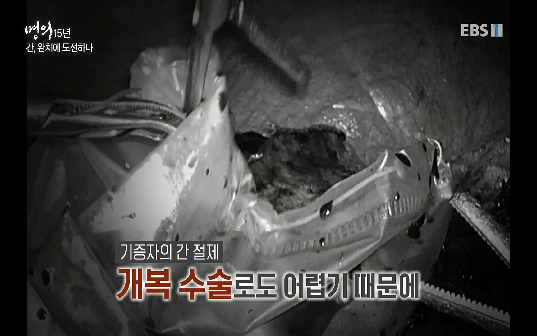 EBS 명의 헬스케어 - TV - 교육의 중심 EBS명의 15년 - 간, 완치에 도전하다.mp4_20220802_202422.498.jpg