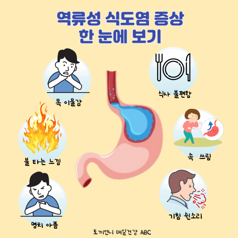역류성 식도염증상기해의 원인 치료방법 2