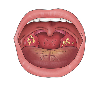 편도선이 붓는 이유