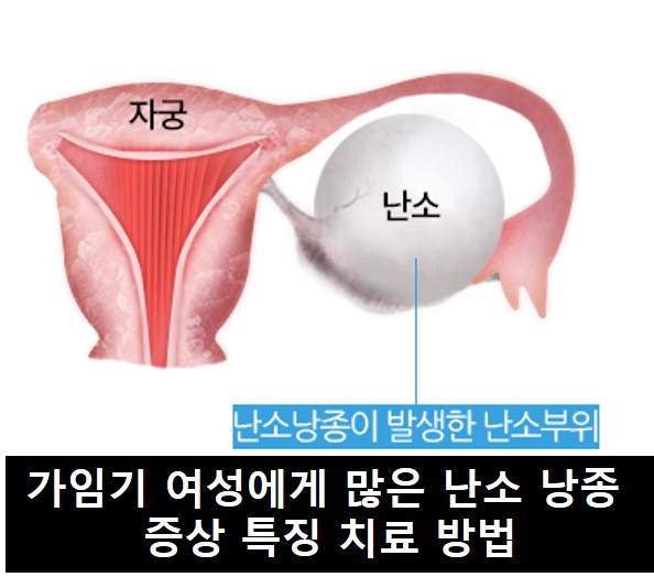 난소낭종 부위