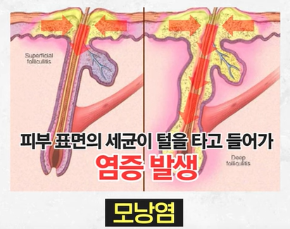 모낭염