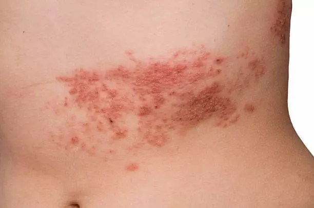 대상포진 초기증상 치료방법