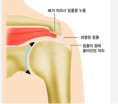 회전근개 파열의 원인,